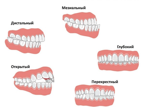 nepravilnyiy-prikus